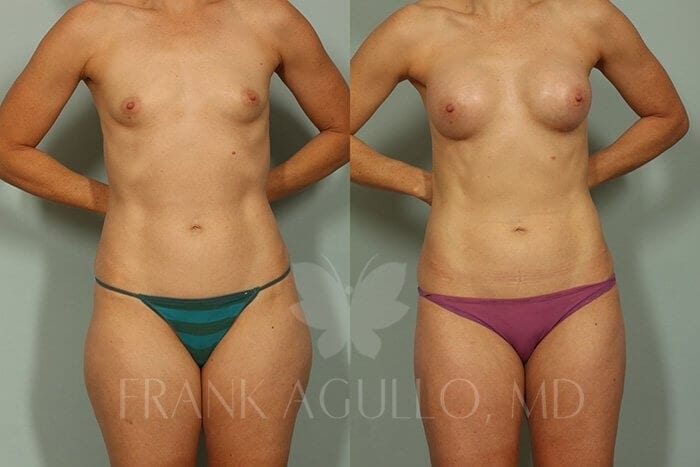 Liposuction Before and After 11