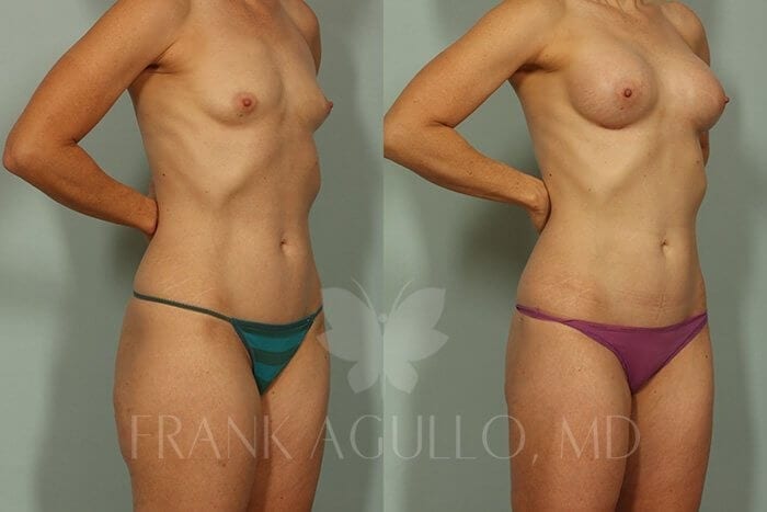 Liposuction Before and After 2