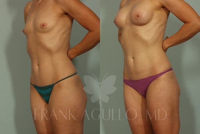 Liposuction Before and After 3