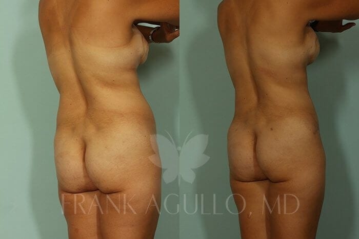 Liposuction Before and After 10