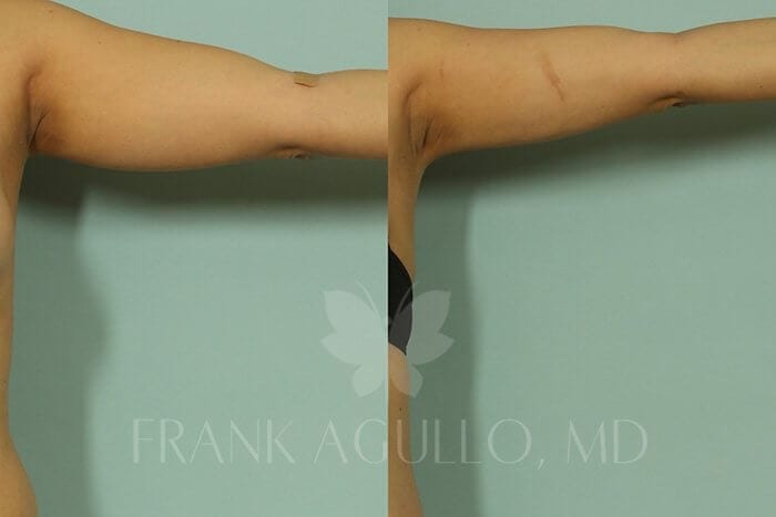 Liposuction Before and After 8