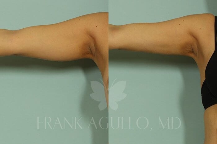 Liposuction Before and After 2