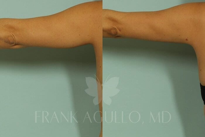 Liposuction Before and After 3