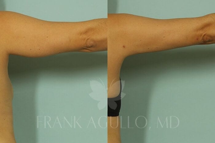 Liposuction Before and After 4