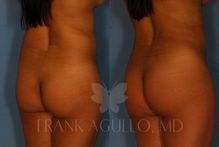Liposuction Before and After 7