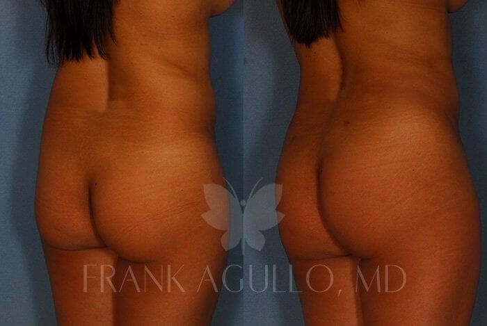 Liposuction Before and After 7