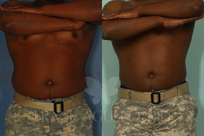 Liposuction Before and After 6