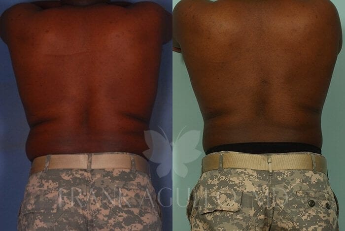 Liposuction Before and After 2