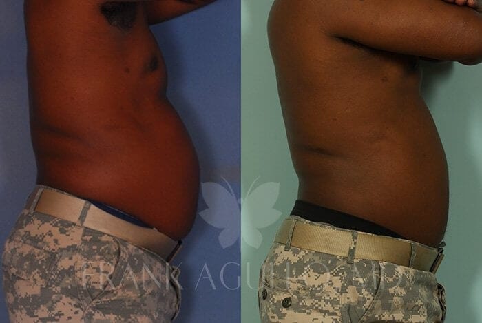 Liposuction Before and After 3