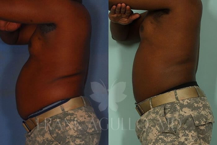 Liposuction Before and After 4