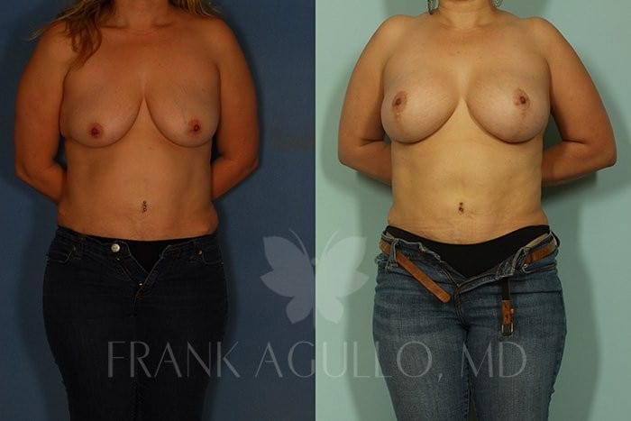 Breast Lift Before and After 15