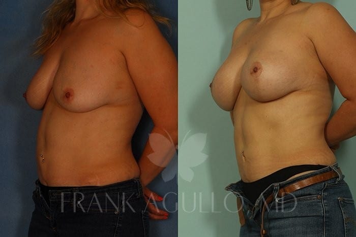 Breast Lift Before and After 2