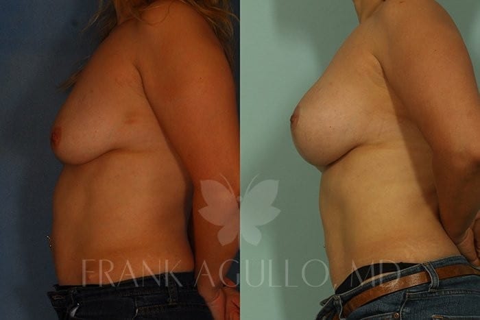 Breast Lift Before and After 3