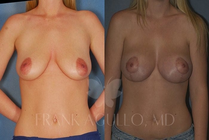 Breast Before and After 7