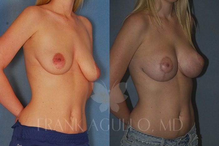 Breast Lift Before and After 2