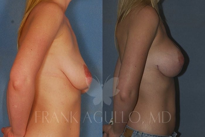 Breast Lift Before and After 3