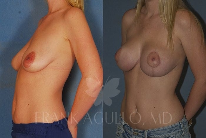 Breast Lift Before and After 4