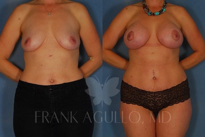Breast Lift Before and After 2