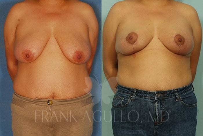 Breast Before and After 16