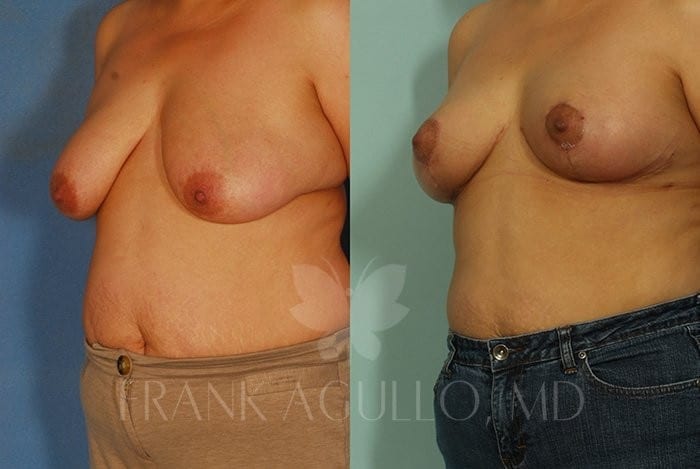 Breast Lift Before and After 2