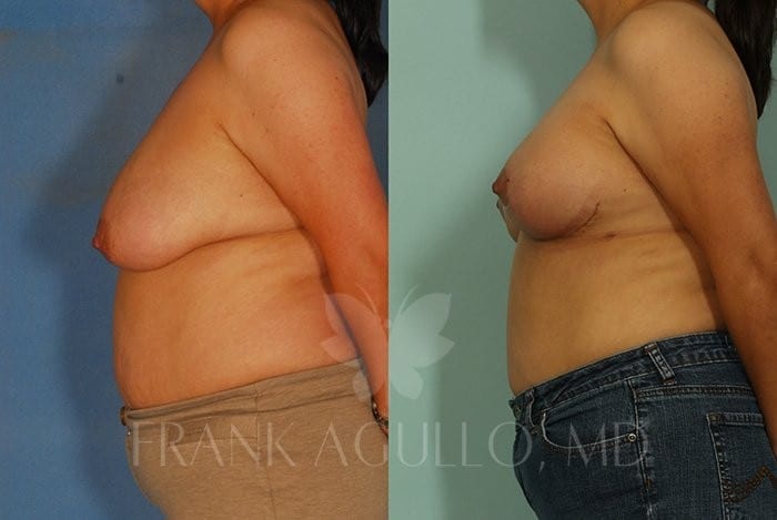 Breast Lift Before and After 3