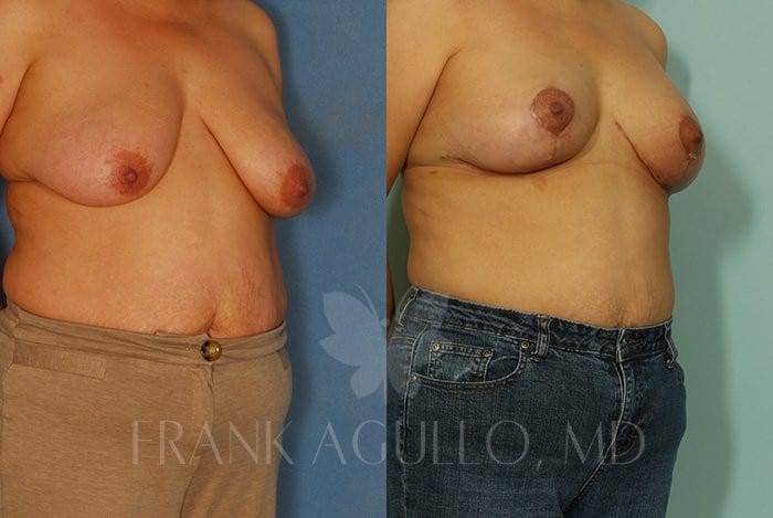 Breast Lift Before and After 4