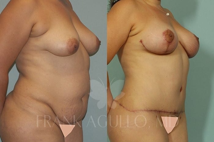 Breast Lift Before and After 2