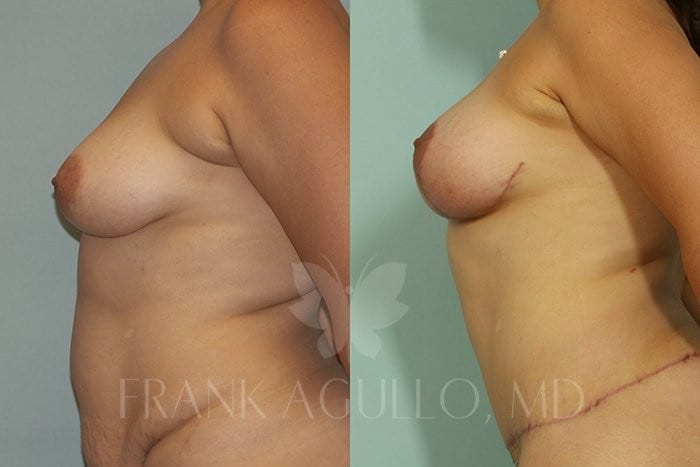 Breast Lift Before and After 3
