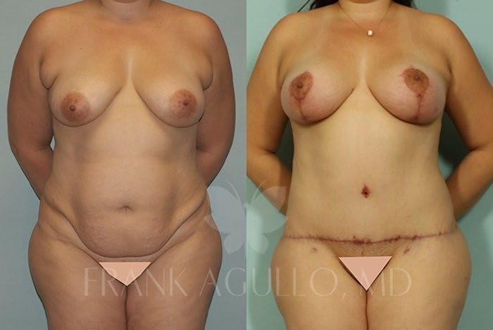 Breast Lift Before and After 4