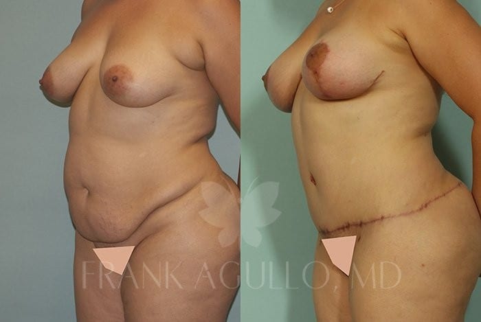 Breast Lift Before and After 7