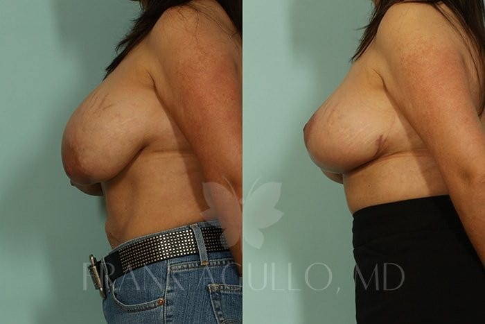 Breast Lift Before and After 4