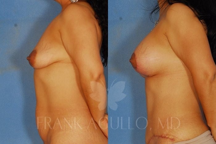 Breast Lift Before and After 2