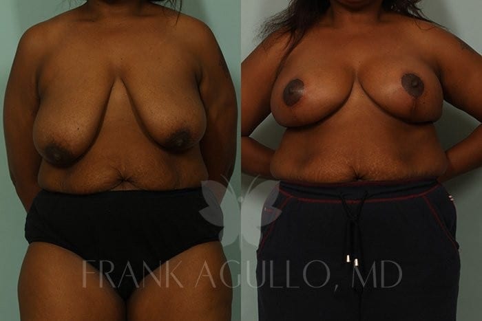 Breast Lift Before and After 10