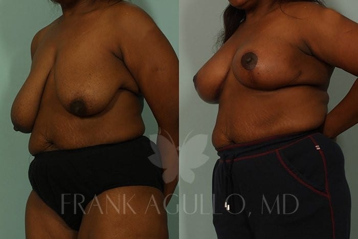 Breast Lift Before and After 2