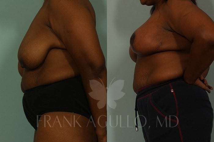 Breast Lift Before and After 3