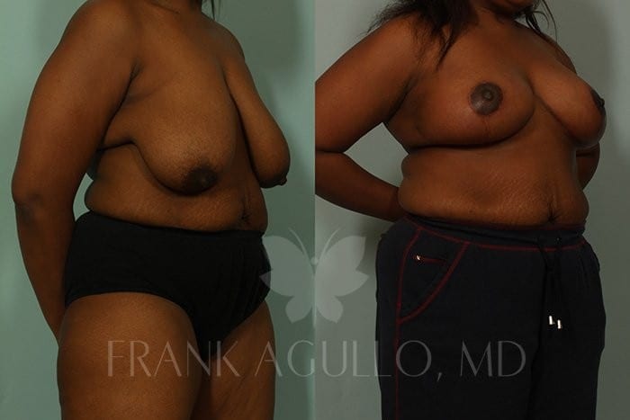 Breast Lift Before and After 4