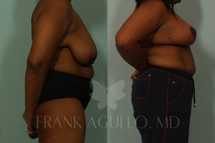 Breast Lift Before and After 5