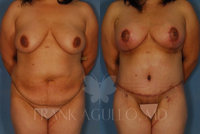 Breast Lift Before and After 2