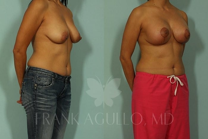 Breast Lift Before and After 3