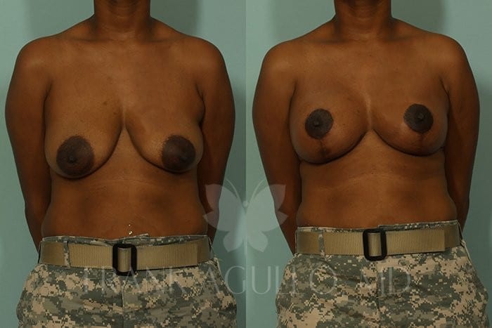 Breast Lift Before and After 2