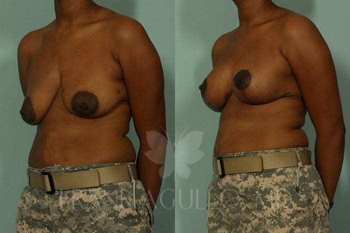 Breast Lift Before and After 3