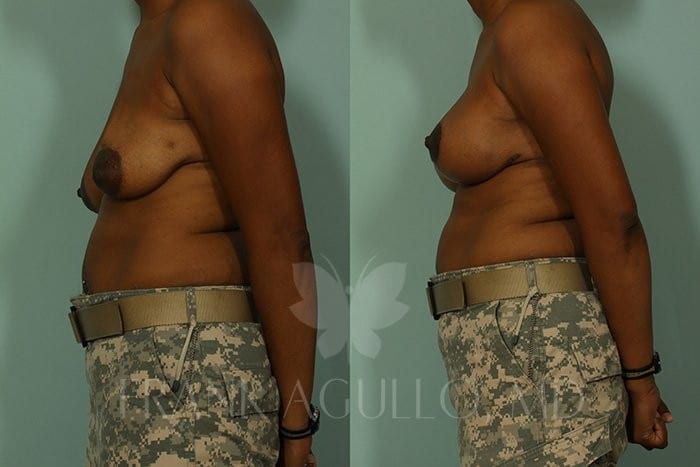 Breast Lift Before and After 4