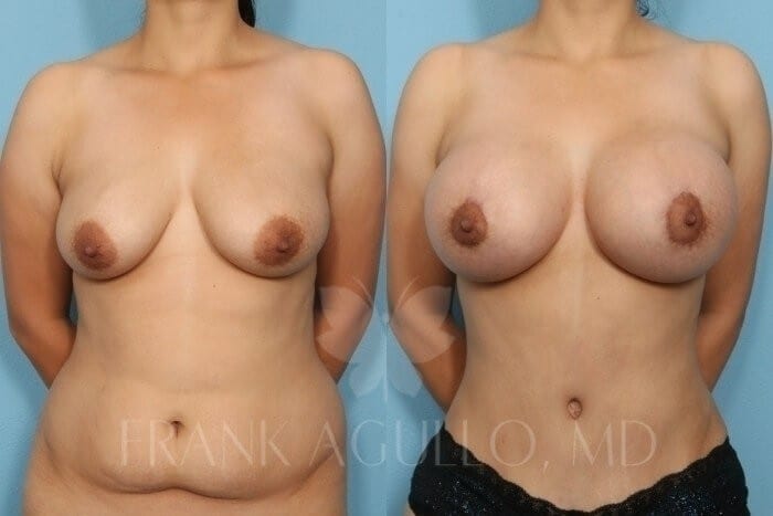 Mommy Makeover Before and After 2