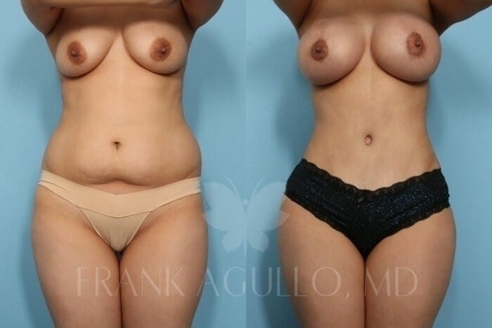 Mommy Makeover Before and After 3