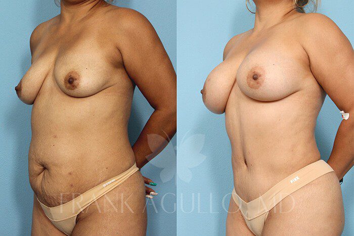 Mommy Makeover Before and After 2