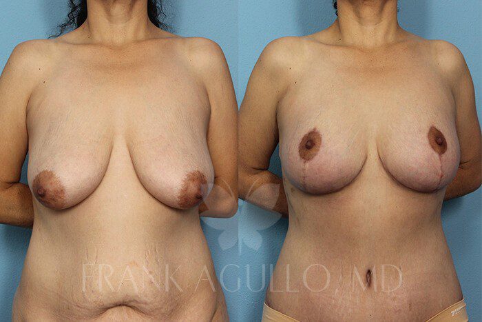 Mommy Makeover Before and After 2