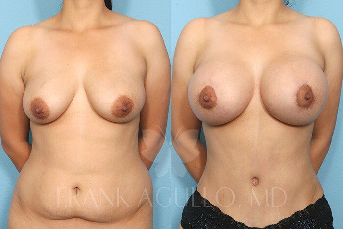 Mommy Makeover Before and After 2