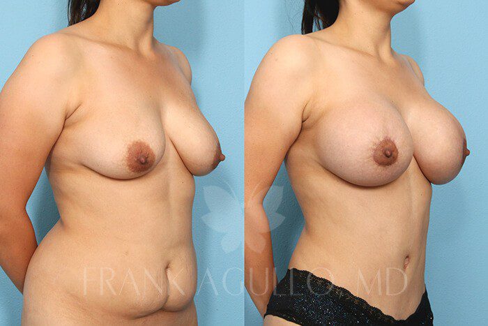 Mommy Makeover Before and After 3