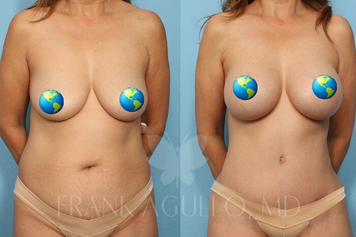 Mommy Makeover Before and After 2