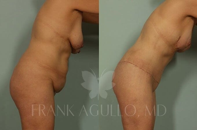 Mommy Makeover Before and After 6